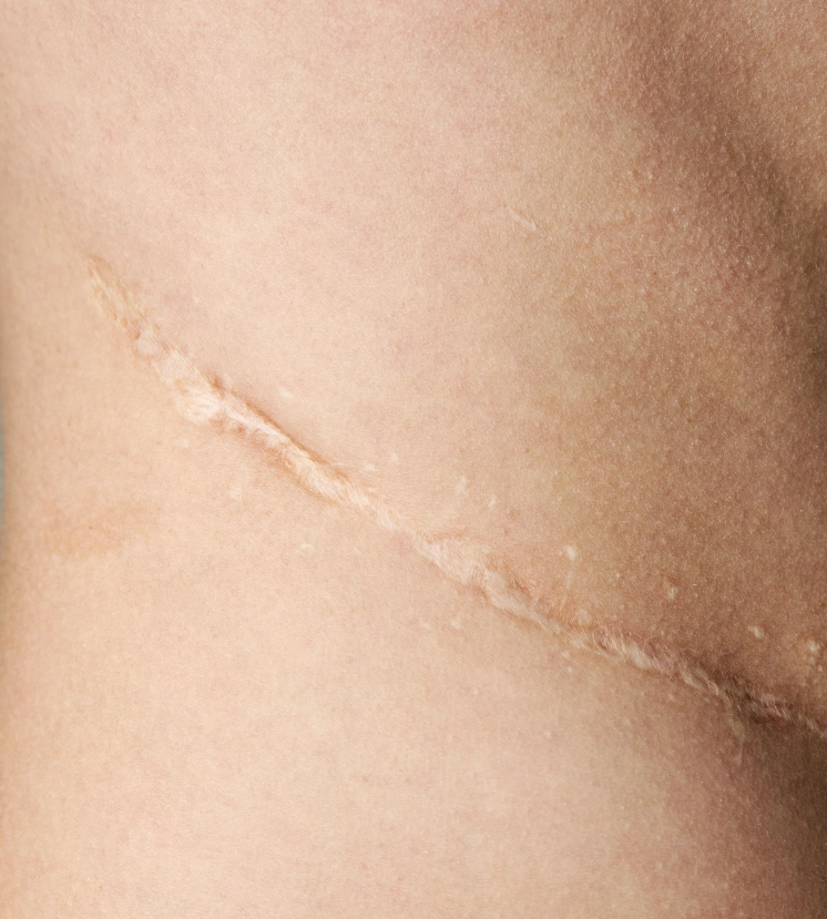 Conçu pour le soin des cicatrices de césariennes, efficace pour toutes les cicatrices